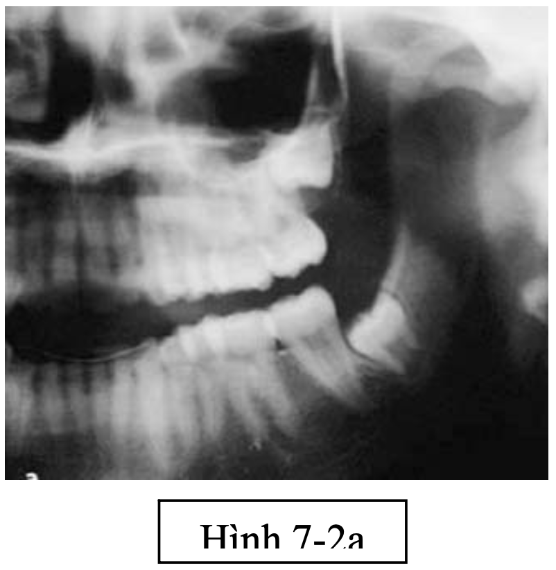 Phẫu thuật lấy mầm răng